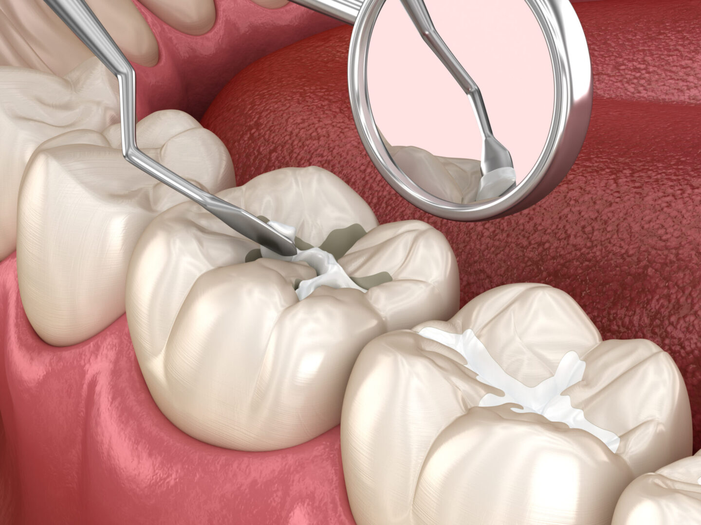 Dental procedure illustration showing a filling being placed in a tooth using tools, with a dental mirror reflecting the process.
